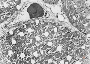 F,58y. | myocardial steatosis F,58y. | myocardial steatosis